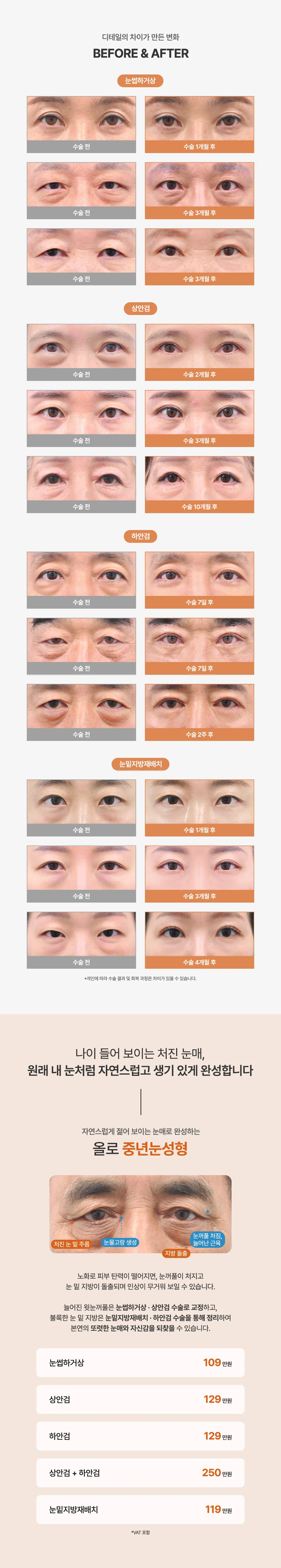 올로 중년눈성형 비포애프터